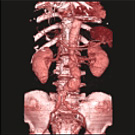 腹部・大動脈瘤